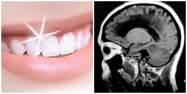 dientes_y_demencia